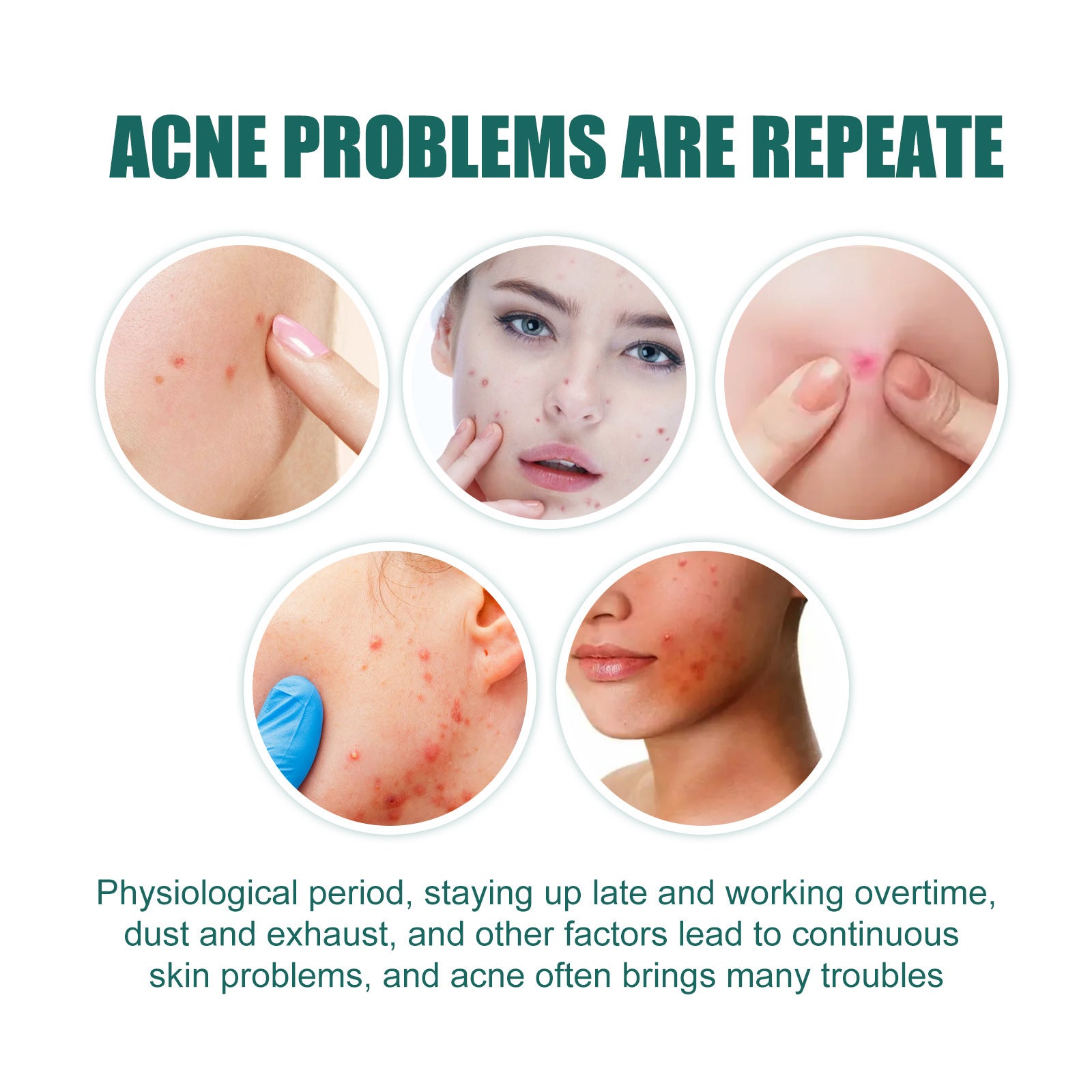 Hydrocolloid Acne Patch with Tea Tree and Calendula | Gentle Spot Care for Blemishes and Redness