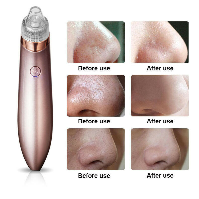 Electric Blackhead Vacuum Pore Cleaner | Rechargeable Pore Vacuum and Skin Exfoliation Tool